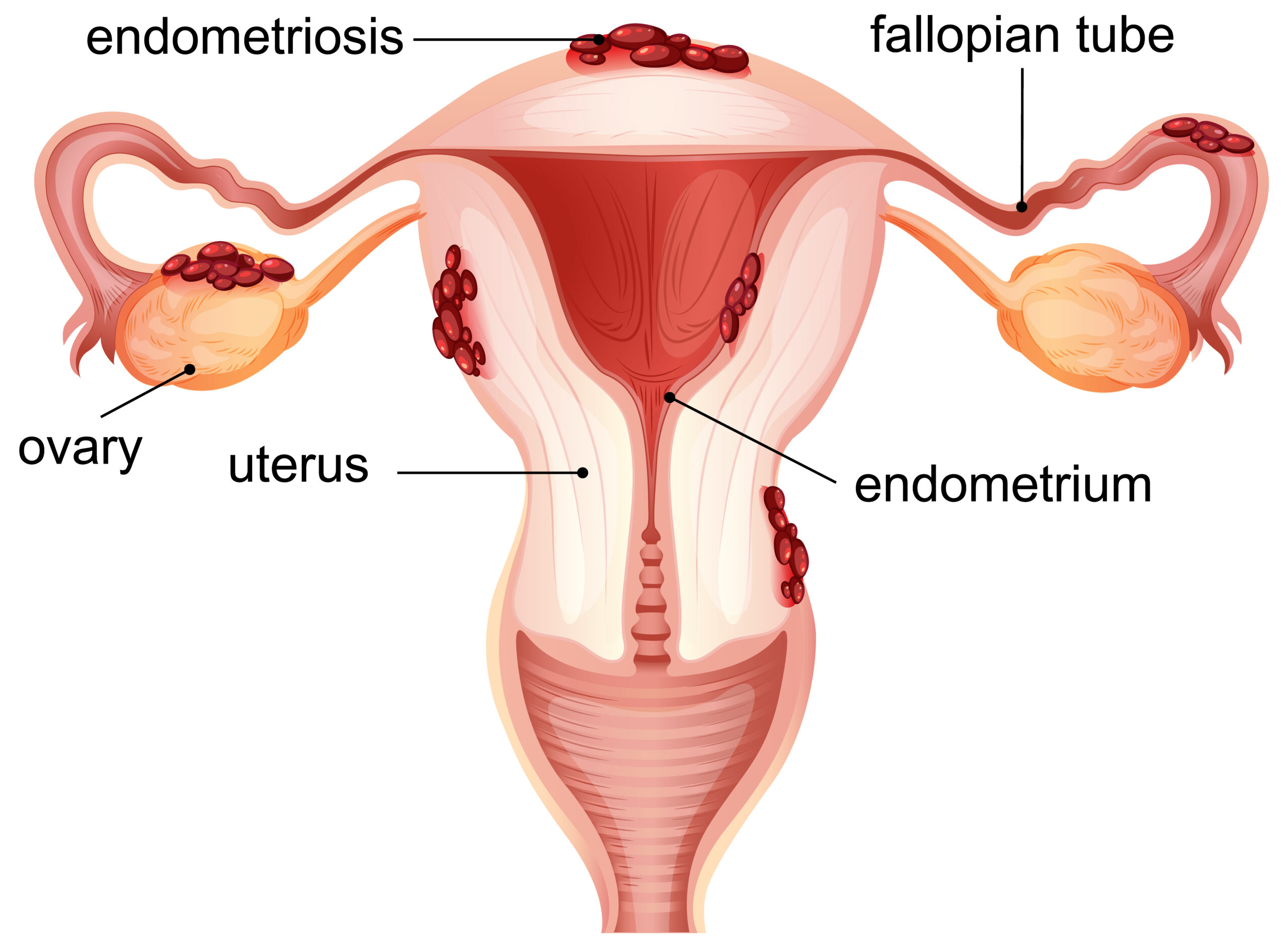Early Signs of Endometriosis Every Woman Should Know